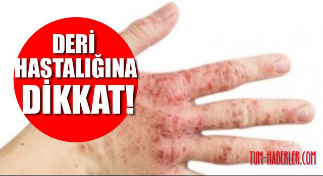 Deri hastalıkları korona virüs belirtileri arasına girdi
